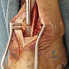 تشخيص وعلامات اعتلال وتر أخيل