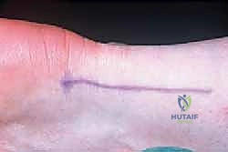 العلاج الجراحي المفتوح والترميم لالتهاب وتر أخيل المزمن: دليل شامل للمرضى مع الأستاذ الدكتور محمد هطيف