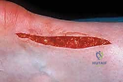 تخطيط الشق الجراحي لوتر أخيل