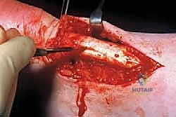 صورة للرنين المغناطيسي توضح التهاب وتر أخيل