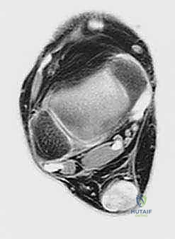 عملية التنظيف الدقيق واستئصال الأنسجة الميتة