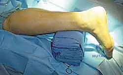 خياطة الأوتار لتعزيز القوة الميكانيكية