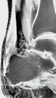 استخراج الأنسجة التالفة من وتر أخيل