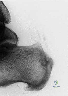 فحص وتقييم حالة وتر أخيل المتضرر