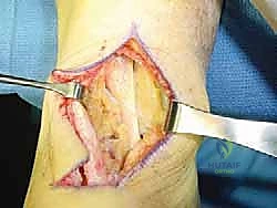 الدكتور هطيف أثناء إجراء تدخل جراحي دقيق