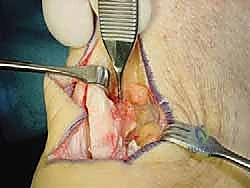 تجهيز وتر FHL للنقل الجراحي