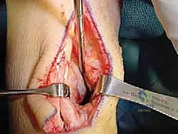 عزل وتر FHL بأمان تام