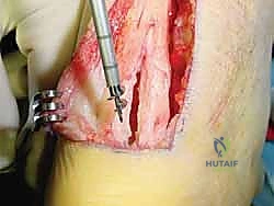 صورة طبية: نقل وتر فليكسور هالوسيس لونجوس (FHL