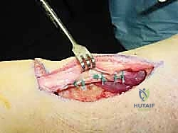 صورة توضيحية لـ نقل وتر فليكسور هالوسيس لونجوس (FHL) لعلاج التهاب وتر أخيل المزمن: دليل شامل للمرضى