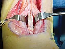 صورة توضيحية لـ نقل وتر فليكسور هالوسيس لونجوس (FHL) لعلاج التهاب وتر أخيل المزمن: دليل شامل للمرضى