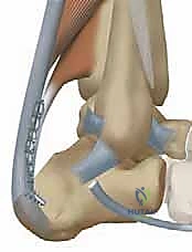 صورة توضيحية لـ نقل وتر فليكسور هالوسيس لونجوس (FHL) لعلاج التهاب وتر أخيل المزمن: دليل شامل للمرضى