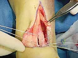 Illustration of hallucis longus transfer - Dr. Mohammed Hutaif