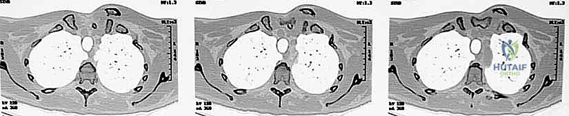 آلية حدوث الإصابة والصدمات