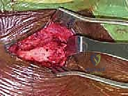 تمرير الأدوات الجراحية بأمان