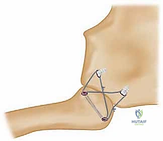 تمرير الرقعة الوترية عبر العظام