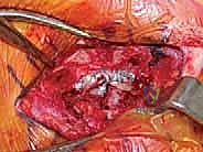 خلع المفصل القصي الترقوي: الأسباب، الأعراض، وطرق العلاج وإعادة البناء مع الأستاذ الدكتور محمد هطيف في صنعاء