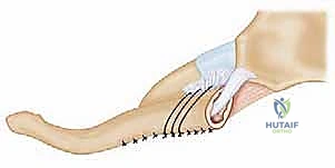 صورة توضيحية لـ خلع المفصل القصي الترقوي: الأسباب، الأعراض، وطرق العلاج وإعادة البناء مع الأستاذ الدكتور محمد هطيف في صنعاء