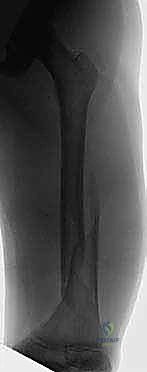 Illustration of screw is inserted - Dr. Mohammed Hutaif