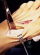 صورة توضيحية لـ عملية قطع العظم الوتدي القريب المغلق: الحل المتقدم لتصحيح الوكعة الإبهامية المعقدة مع الأستاذ الدكتور محمد هطيف في صنعاء