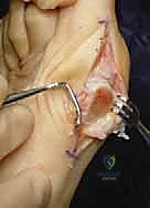 صورة توضيحية لـ عملية قطع العظم الوتدي القريب المغلق: الحل المتقدم لتصحيح الوكعة الإبهامية المعقدة مع الأستاذ الدكتور محمد هطيف في صنعاء