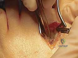 صورة توضيحية لـ عملية قطع العظم الوتدي القريب المغلق: الحل المتقدم لتصحيح الوكعة الإبهامية المعقدة مع الأستاذ الدكتور محمد هطيف في صنعاء