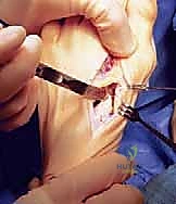 صورة توضيحية لـ عملية قطع العظم الوتدي القريب المغلق: الحل المتقدم لتصحيح الوكعة الإبهامية المعقدة مع الأستاذ الدكتور محمد هطيف في صنعاء