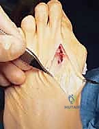 صورة توضيحية لـ عملية قطع العظم الوتدي القريب المغلق: الحل المتقدم لتصحيح الوكعة الإبهامية المعقدة مع الأستاذ الدكتور محمد هطيف في صنعاء