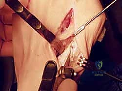 صورة توضيحية لـ عملية قطع العظم الوتدي القريب المغلق: الحل المتقدم لتصحيح الوكعة الإبهامية المعقدة مع الأستاذ الدكتور محمد هطيف في صنعاء