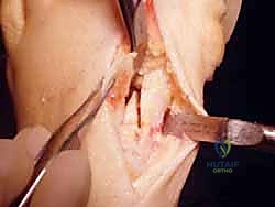 صورة توضيحية لـ عملية قطع العظم الوتدي القريب المغلق: الحل المتقدم لتصحيح الوكعة الإبهامية المعقدة مع الأستاذ الدكتور محمد هطيف في صنعاء