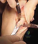 صورة توضيحية لـ عملية قطع العظم الوتدي القريب المغلق: الحل المتقدم لتصحيح الوكعة الإبهامية المعقدة مع الأستاذ الدكتور محمد هطيف في صنعاء