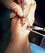 صورة توضيحية لـ عملية قطع العظم الوتدي القريب المغلق: الحل المتقدم لتصحيح الوكعة الإبهامية المعقدة مع الأستاذ الدكتور محمد هطيف في صنعاء