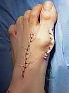 صورة توضيحية لـ عملية قطع العظم الوتدي القريب المغلق: الحل المتقدم لتصحيح الوكعة الإبهامية المعقدة مع الأستاذ الدكتور محمد هطيف في صنعاء