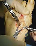 عملية قطع العظم الوتدي القريب المغلق: الحل المتقدم لتصحيح الوكعة الإبهامية المعقدة مع الأستاذ الدكتور محمد هطيف في صنعاء