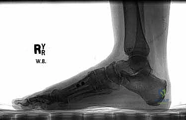 Proximal Closing Wedge Osteotomy: A Masterclass in Hallux Valgus Correction