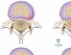 الأعراض السريرية للانزلاق الغضروفي وعرق النسا