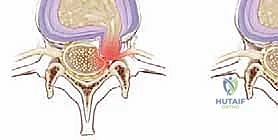 استئصال الغضروف المجهري القطني: دليل شامل للمرضى من الأستاذ الدكتور محمد هطيف