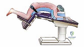 صورة توضيحية لـ استئصال الغضروف المجهري القطني: دليل شامل للمرضى من الأستاذ الدكتور محمد هطيف