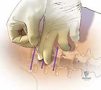 صورة طبية: استئصال الغضروف المجهري القطني: دليل شامل للمرضى من الأستاذ الدكتور محمد هطيف