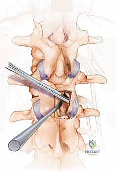 تشريح العمود الفقري القطني والأقراص الغضروفية