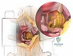 عوامل الخطر المؤدية للانزلاق الغضروفي