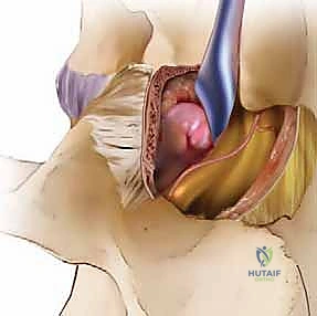 صورة توضيحية لـ استئصال الغضروف المجهري القطني: دليل شامل للمرضى من الأستاذ الدكتور محمد هطيف