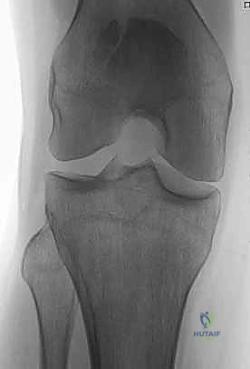 الرباط الشبكي للرضفة وأهميته