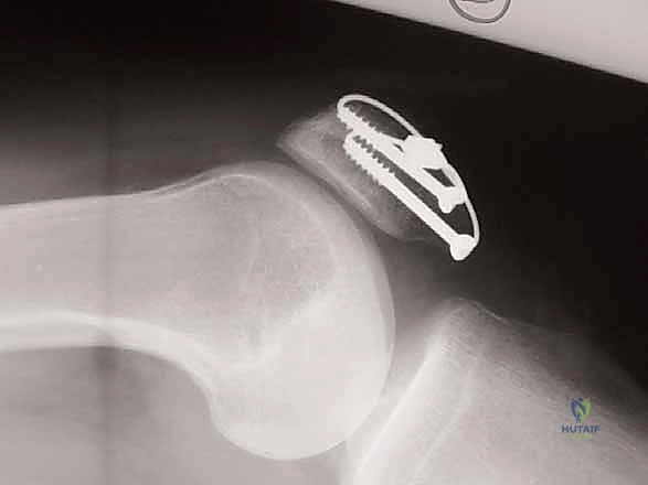 صورة توضيحية لـ كسر الرضفة: دليل شامل لعملية التثبيت الداخلي بالأسلاك (ORIF) مع الأستاذ الدكتور محمد هطيف