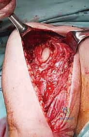 Illustration of internal fixation device - Dr. Mohammed Hutaif