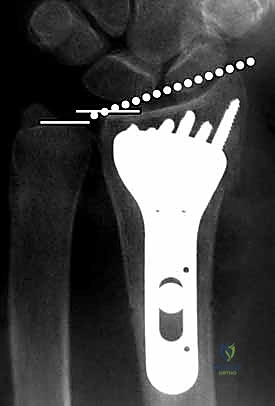 Illustration of lobster claw clamp - Dr. Mohammed Hutaif