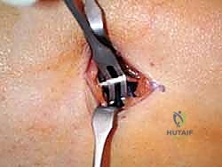 تشريح وتر بلانتارس وعلاقته بعضلة الساق والتراكيب المجاورة