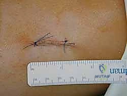 أبرز إصابات القدم والكاحل التي تستدعي التدخل الجراحي والترقيع