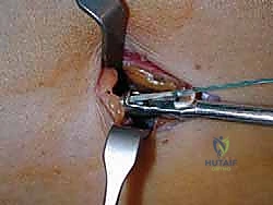 مقارنة قوة الشد لوتر بلانتارس مع الأوتار الذاتية الأخرى