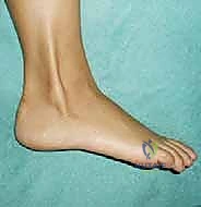 صورة توضيحية لـ إصلاح وإعادة بناء أوتار الشظية (البرونيال): دليل شامل لمرضى الكاحل