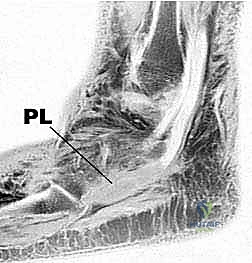 تشخيص تمزقات أوتار الكاحل الجانبية